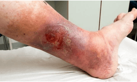 LOPERADERM™ - (Arbetsnamn)